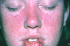 - 80% of systemic lupus erythematous have problems w/ skin (some only have problems w/ skin - chronic cutaneous lupus)
- Malar (cheek) erythema
- Discoid (chronic/thick) lesions
- Oral ulcers
- Photosensitivity 
- Diffuse alopecia
- Bullous ...