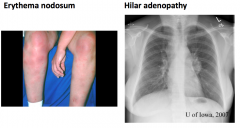 Sarcoidosis
- These 3 symptoms are called "Lofgren's Syndrome"