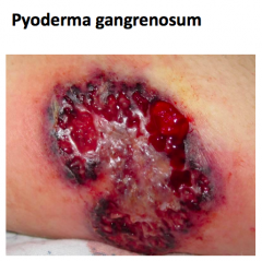 Pyoderma Gangrenosum
- Sterile, rapid ulceration of skin
- Neutrophilic infiltration
- Dusky border

Also:
- Inflammatory arthritis hematologic problems, and maliganncies