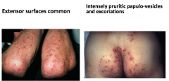 Dermatitis Herpetiformis
- Consequence of gluten sensitivity
- Much less common than prevalence of celiac disease
- Anti-tissue TRANSGLUTAMINASE Abs attach to skin
- Very pruritic: leads to excoriations (from papules/vesicles)
- Especially on...