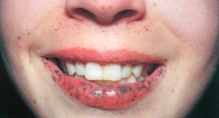- Periorificial lentiginosis (brown-black macules on skin by mouth, lips, buccal mucosa, nails, digits, palms and soles

Associated with:
- Hamartomatous polyps of sm > lg intestine (obstruction and adenocarcinoma)
- Increased ovarian, breast ...