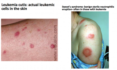 - Leukemia cutis: leukemic cells in skin
- Sweet's syndrome: benign sterile neutrophilic eruption (often in leukemia)