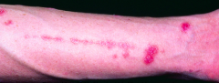 Development of skin lesions at sites of injury (psoriasis)