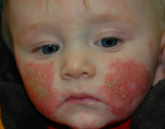 – Facial involvement predominates early – Tends to spare midface
– Oozing, crusting common
– Exacerbated by saliva, foods
– Extensor involvement late infancy
– Sparing of diaper area