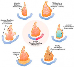 - Increased thickness of alveolar membrane (alveolar fibrosis): pulmonary edema and scarring of alveolar membrane
- Alveolar collapse: atelectasis
- Alveolar-capillary destruction: emphysema
- Interstitial edema
- Frothy secretions: pulmonary ...
