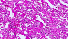 Hyaline membrane disease - dense pink membranous structures that are covering most of the alveolar surface