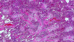 Organizing pneumonia
- Characterized by fibroblastic plugs (balls of fibroblastic tissue fills alveolar spaces)