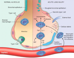 - Damage to epithelial cells lining alveoli
- Damage to endothelial cells
- As a result of damage, there is necrosis of type 1 alveolar cells
- Leakage of neutrophils and edema / fluid into alveolar spaces
- Leads to cytokine release that perp...