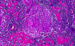 Granuloma - collection of histiocytes