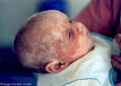 A child born to a mom with SLE has the above rash --- what antibody did the mom have?