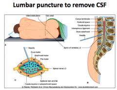 To remove CSF (like if you want to test for meningitis).

Performed around the L4 area, where the Cauda Equina is located.

This procedure does not cause damage to the spinal cord because it is like "trying to hit spaghetti"