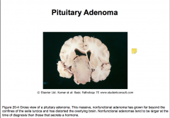 Pituitary Adenoma
-What do patients present with?