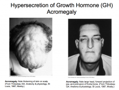 excess growth in chin, forehead, zygomatic process
-the face continues to grow normally through life but NOT to this extent
