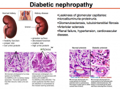 microvascular disease

Characterized by narrowing of renal arterioles & glomerular capillaries