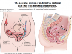 Occurs when endometrial tissue implants somewhere other than the uterus.

Tissue that metastasizes to other areas of the body will still respond to hormones and proliferate and slough off each both