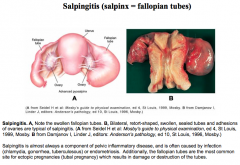 Inflammation of the fallopian tube.

Usually associated with pelvic inflammatory disease (PID).

Usually caused by infection, endometriosis, or ectopic pregnancy.