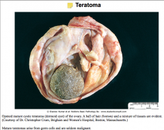 These are germ cells that wanted to become a person but didn't quite make it.

These are encapsulated tumors with tissue or organ components inside.

Teratomas are generally benign, but are still surgically removed