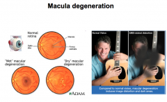 Degeneration of macula causes central blindness. Lose vision only in the middle of our visual field where most of our visual power lies.