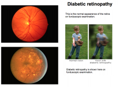 Increased vascular permeability and angiogenesis destroys retina.