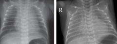 What do these chest x-rays show?
