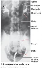 *numbers indicate ureter constrictions
1. ureteropelvic junction
2. pelvic brin
3. ureterovesicular junction