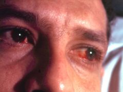 35 year old man comes to GP with red painful eye, have watery discharge from both eyes, it started from one eye and spread to another. Daughter also had red eye 2 weeks ago. 

Dx, List cause, features, treatment and prognosis