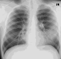 Case 2
- 18 yo previously healthy presents w/ SOB and fever
- HR 94, RR 20, BP 118/74, T 39°C, SaO2 94%
- He has rhonchi heard best in L base
- Chest x-ray obtained
- Albuterol (β2 agonist) inhalation treatment is ordered by intern and SaO2...
