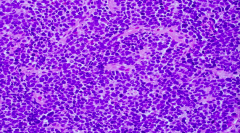 Small cell carcinoma / malignancy