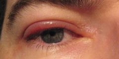 17 year old boy present with swelling of upper eyelid bilaterally, feeling burning and grittiness in the eye

Dx, Treatment