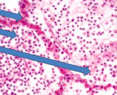 Congestion (first 24 hours)
- Top arrow: vascular engorgement
- Middle arrow: neutrophil migration
- Bottom arrow: intra-alveolar fluid