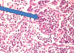 Red Hepatization (2-3 days)
- Confluent exudate w/ RBCs and neutrophils
- Red, firm and airless lung
- "Liver-like" consistency
