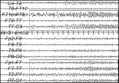 - Indicating abnormalities in about 95% of cases

- specific EEG patterns are associated with many epilepsy syndromes and assist in formal diagnosis

- In about 30% of cases: Epileptic abnormalities in routine recordings (20-30 minutes duratio...