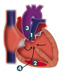 PROVe
1. Pulmonary infundibular stenosis (most important determinant for prognosis)
2. RV hypertrophy (boot shaped heart on CXR)
3. Overriding aorta
4. VSD

Pulmonary stenosis forces R→L flow across VSD → early cyanotic "tet spells" and ...