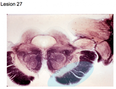 Superior alternating hemiplegia (Weber's) - thrombosis of branch of posterior cerebral a. or tumor at base of rostral midbrain