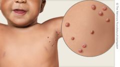 Molluscum contagiosum (MC) is a viral infection of the skin or occasionally of the mucous membranes, sometimes called water warts. It is caused by a DNA poxvirus called the molluscum contagiosum virus (MCV). The virus that causes molluscum is spre...
