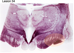 Thrombosis of a branch of post. cerebral a. or tumor mass in crus cerebri at base of caudal diencephalon 