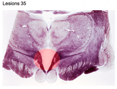 Midline tumor mass in caudal hypothalamus 