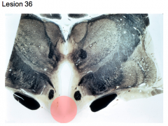 Tumor in midline of hypothalamus approximately halfway through its rostrocaudal extent (rostral thalamus/mid hypothalamus)