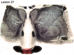 Pituitary tumor herniated out of the sella turcica and pressing on base of anterior hypothalamus 