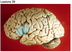 Thrombosis of branch of middle cerebral a. (left cerebral hemisphere)