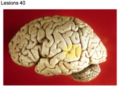 Thrombosis of branch of middle cerebral a. (left cerebral hemisphere)