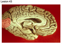 Thrombosis of branch of posterior cerebral a. (medial hemispheric wall)