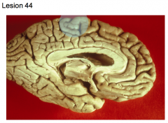 Meningioma in the falx cerebri growing laterally to affect only one hemisphere 