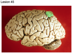 Localized (focal) meningioma (left cerebral hemisphere)