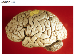 Small localized tumor (left cerebral hemisphere)