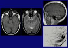 Treat on Arterial Side-
If Not successful, try to completely occlude venous sinus.