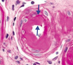 Hyaline Arteriolosclerosis