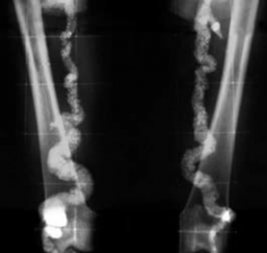 What is the term for the usually benign process that causes a "pipestem" appearance of arteries on x-ray? Which arteries are typically affected? Implications?