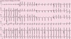 - hypoxia
- copd
- electrolyte imbalances (k+, mg+)
- heart dz (cad, vpt, htn..)
- meds (theophylline..)