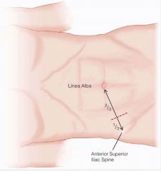 Typically begins in the periumbilical region that peaks in 4-6 hours and then subsides only to retun later in the RLQ at McBurney's point.